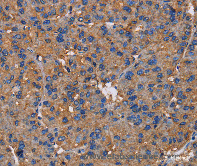 Immunohistochemistry of paraffin-embedded Human liver cancer tissue using NCSTN Polyclonal Antibody at dilution 1:50