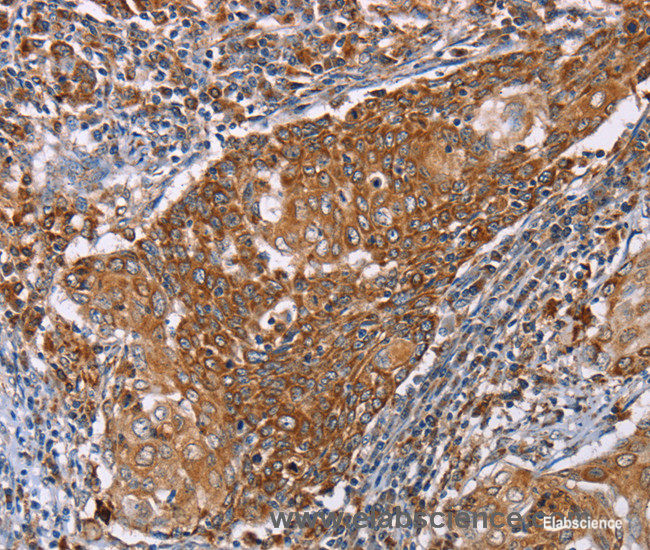 Immunohistochemistry of paraffin-embedded Human cervical cancer tissue using PMPCB Polyclonal Antibody at dilution 1:50