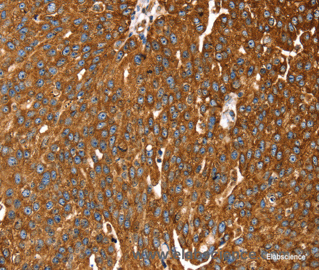 Immunohistochemistry of paraffin-embedded Human breast cancer tissue using RASSF3 Polyclonal Antibody at dilution 1:35