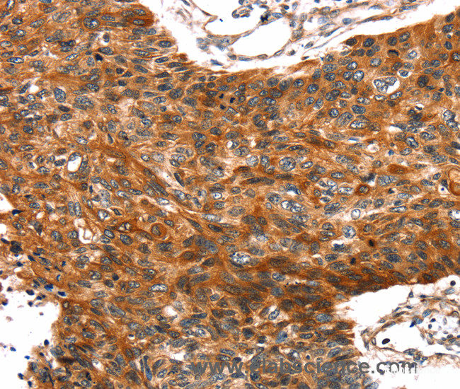 Immunohistochemistry of paraffin-embedded Human esophagus cancer tissue using TRIM69 Polyclonal Antibody at dilution 1:40