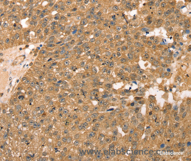 Immunohistochemistry of paraffin-embedded Human breast cancer tissue using RPLP2 Polyclonal Antibody at dilution 1:40