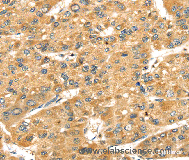 Immunohistochemistry of paraffin-embedded Human liver cancer tissue using SH3KBP1 Polyclonal Antibody at dilution 1:40