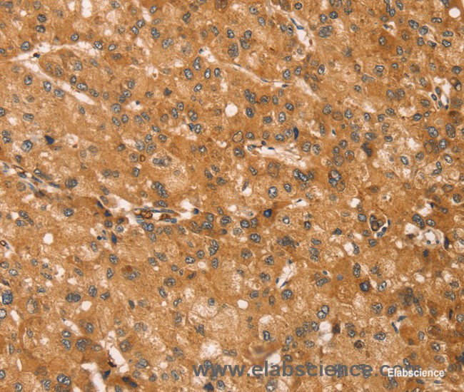 Immunohistochemistry of paraffin-embedded Human liver cancer tissue using SNAP29 Polyclonal Antibody at dilution 1:45