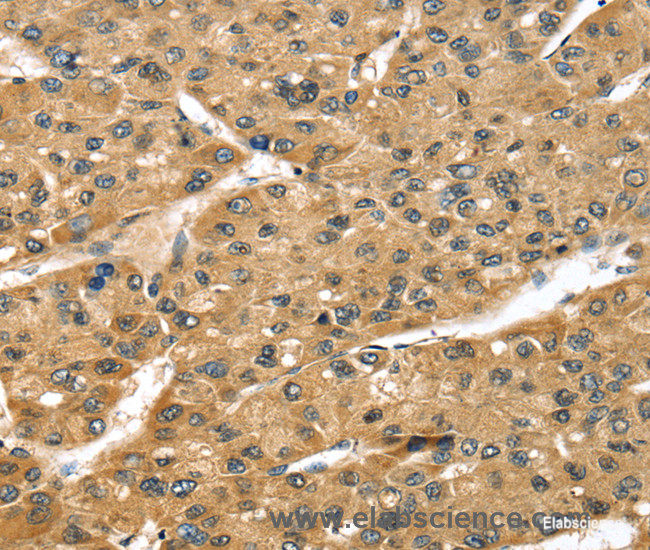 Immunohistochemistry of paraffin-embedded Human liver cancer tissue using STX8 Polyclonal Antibody at dilution 1:45