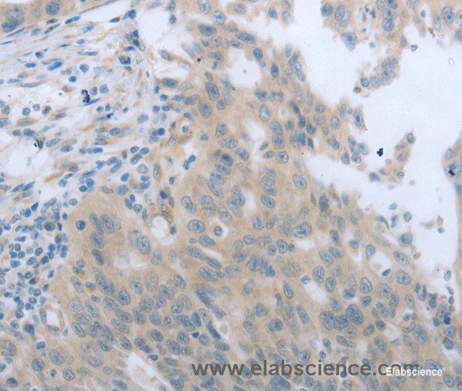 Immunohistochemistry of paraffin-embedded Human breast cancer tissue using TNK2 Polyclonal Antibody at dilution 1:70