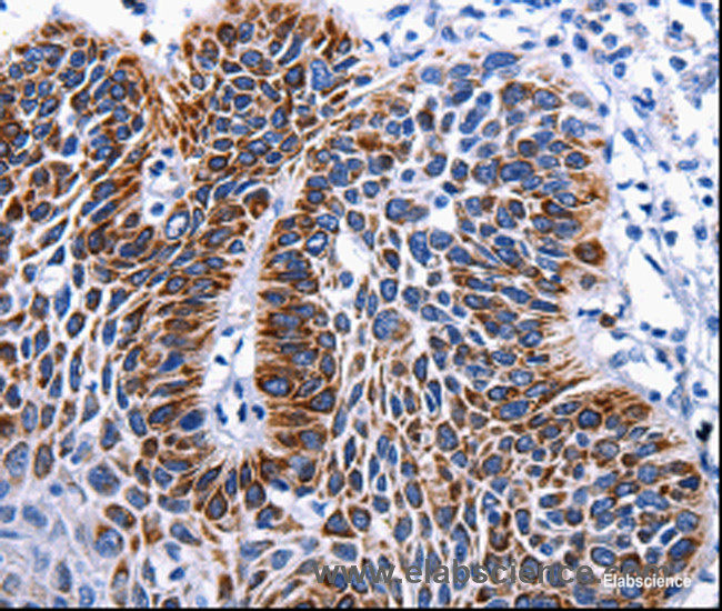 Immunohistochemistry of paraffin-embedded Human liver cancer tissue using RAB25 Polyclonal Antibody at dilution 1:50