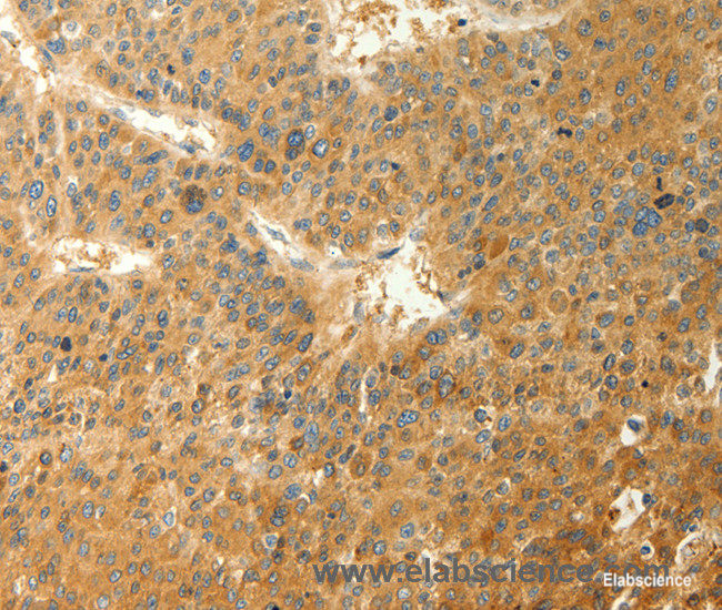 Immunohistochemistry of paraffin-embedded Human liver cancer tissue using RAB35 Polyclonal Antibody at dilution 1:40