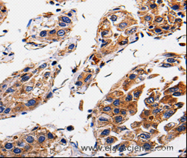 Immunohistochemistry of paraffin-embedded Human gasrtic cancer tissue using RAB41 Polyclonal Antibody at dilution 1:60