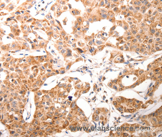 Immunohistochemistry of paraffin-embedded Human ovarian cancer tissue using BGLAP Polyclonal Antibody at dilution of 1:60