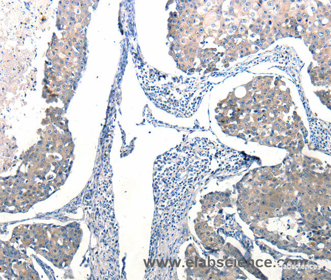 Immunohistochemistry of paraffin-embedded Human breast cancer tissue using Ccl6 Polyclonal Antibody at dilution 1:50