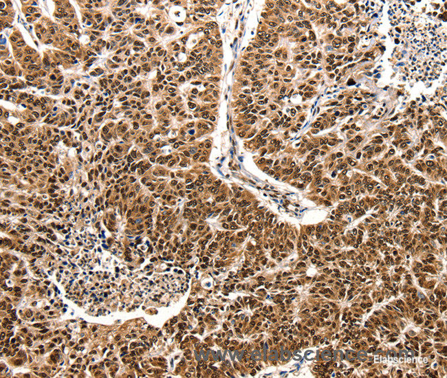 Immunohistochemistry of paraffin-embedded Human lung cancer tissue using CCL2 Polyclonal Antibody at dilution 1:50