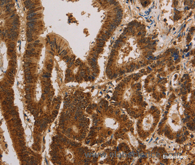 Immunohistochemistry of paraffin-embedded Human colon cancer tissue using CSNK2B Polyclonal Antibody at dilution 1:30