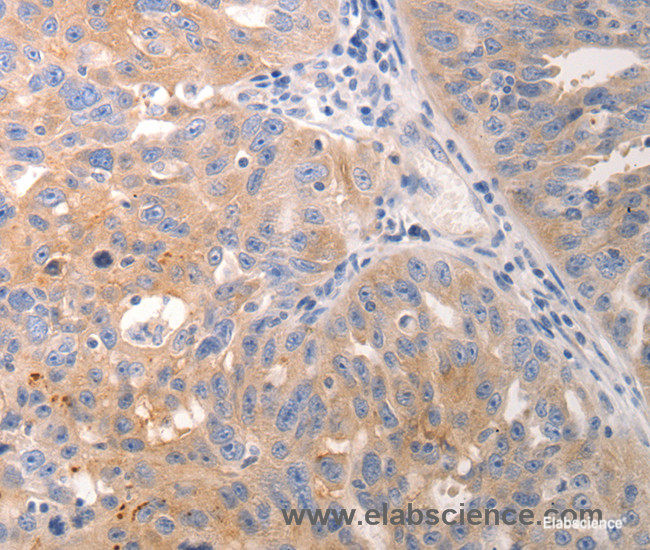 Immunohistochemistry of paraffin-embedded Human breast cancer tissue using CK-6A/B/C Polyclonal Antibody at dilution 1:50