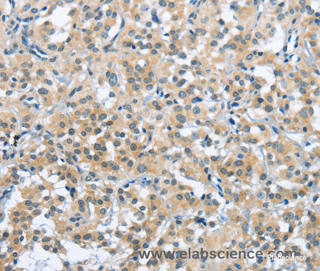 Immunohistochemistry of paraffin-embedded Human thyroid cancer tissue using TRDMT1 Polyclonal Antibody at dilution 1:40