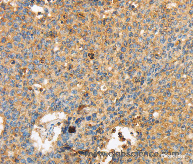 Immunohistochemistry of paraffin-embedded Human lung cancer tissue using ERK 3 Polyclonal Antibody at dilution 1:40
