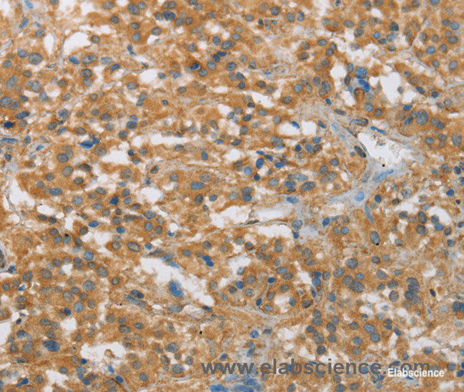 Immunohistochemistry of paraffin-embedded Human thyroid cancer tissue using FASLG Polyclonal Antibody at dilution 1:30