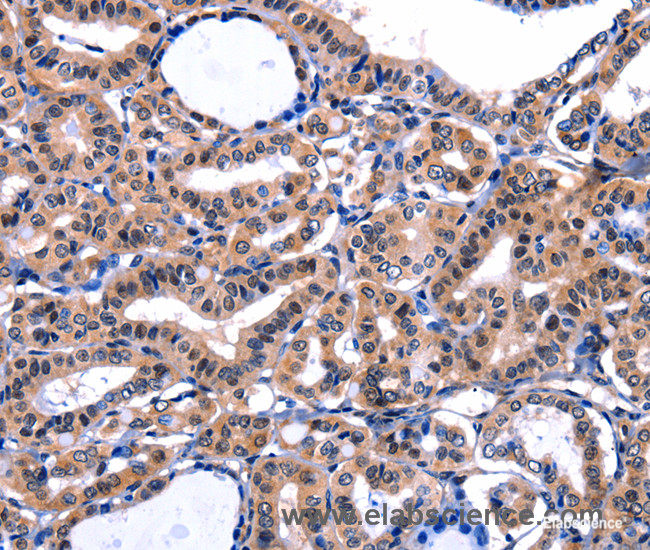 Immunohistochemistry of paraffin-embedded Human thyroid cancer tissue using FBN1 Polyclonal Antibody at dilution 1:47