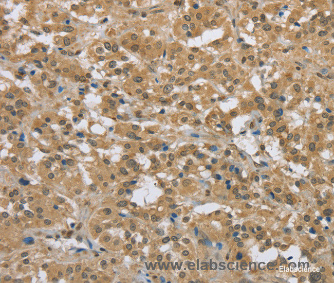 Immunohistochemistry of paraffin-embedded Human thyroid cancer tissue using PKD1 Polyclonal Antibody at dilution 1:50