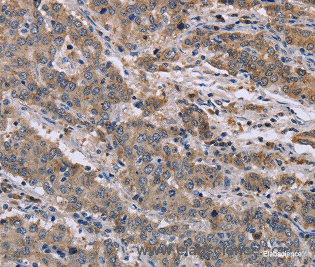 Immunohistochemistry of paraffin-embedded Human liver cancer tissue using GSN Polyclonal Antibody at dilution 1:40