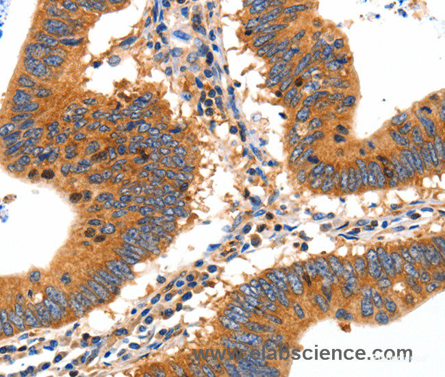 Immunohistochemistry of paraffin-embedded Human colon cancer tissue using SLC2A2 Polyclonal Antibody at dilution 1:30