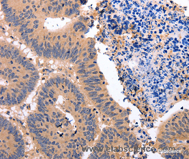 Immunohistochemistry of paraffin-embedded Human colon cancer tissue using Glucocorticoid Receptor Polyclonal Antibody at dilution 1:50