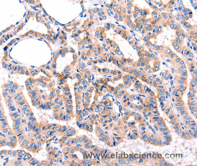 Immunohistochemistry of paraffin-embedded Human thyroid cancer tissue using GRK2 Polyclonal Antibody at dilution 1:87