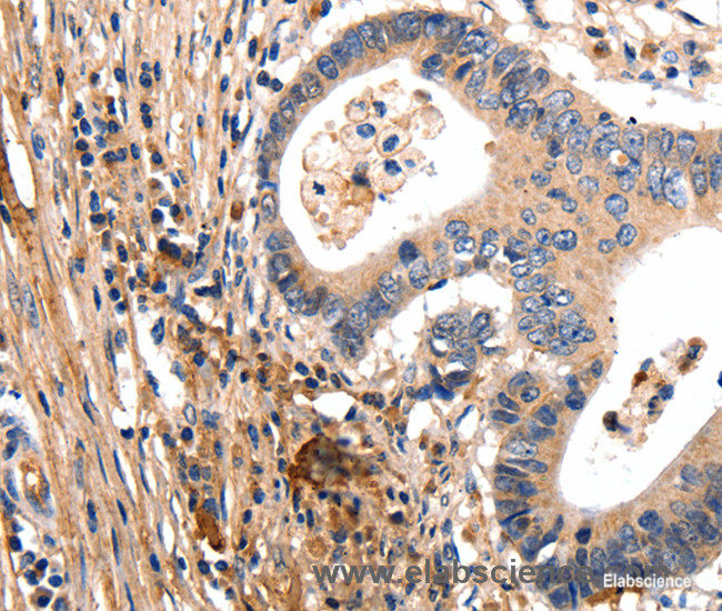 Immunohistochemistry of paraffin-embedded Human colon cancer tissue using GSK3 alpha Polyclonal Antibody at dilution 1:50