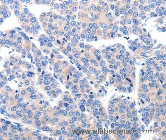 Immunohistochemistry of paraffin-embedded Human ovarian cancer tissue using KCNH8 Polyclonal Antibody at dilution 1:50