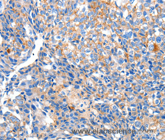 Immunohistochemistry of paraffin-embedded Human breast cancer tissue using HCN2 Polyclonal Antibody at dilution 1:80