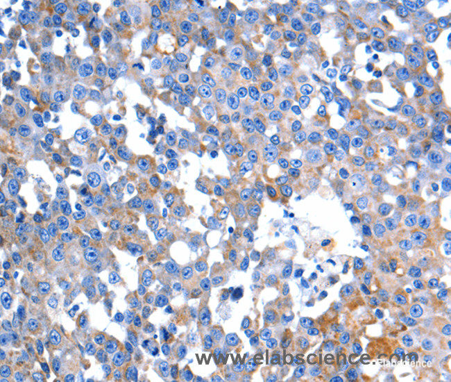 Immunohistochemistry of paraffin-embedded Human breast cancer tissue using HINT2 Polyclonal Antibody at dilution 1:60