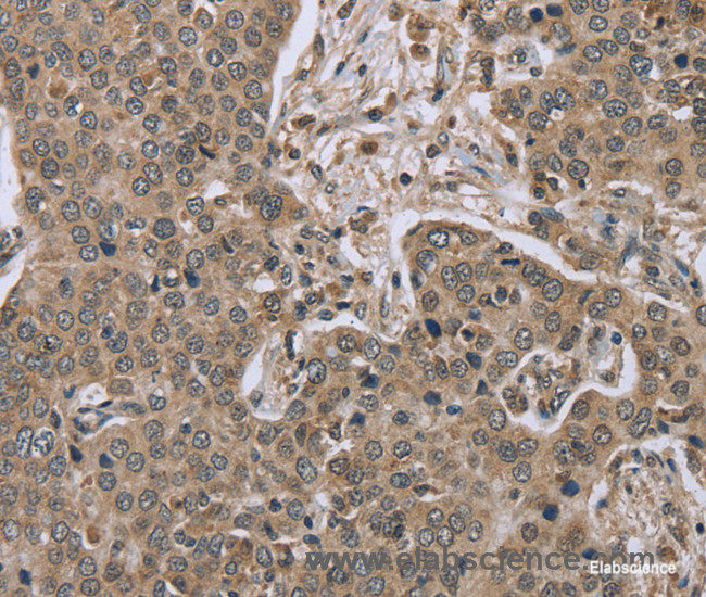 Immunohistochemistry of paraffin-embedded Human liver cancer tissue using IL15RA Polyclonal Antibody at dilution 1:45