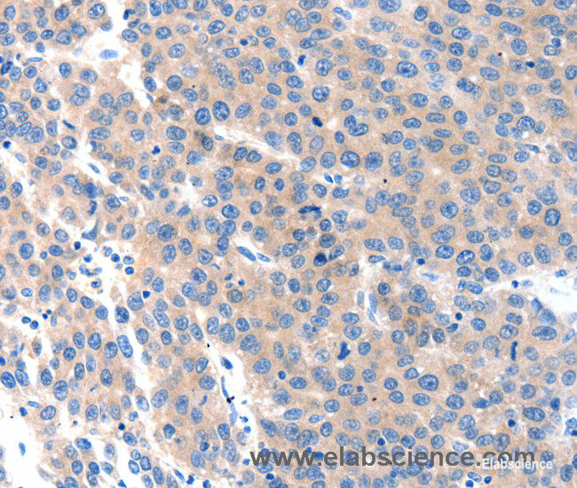 Immunohistochemistry of paraffin-embedded Human liver cancer tissue using KLK2 Polyclonal Antibody at dilution 1:100