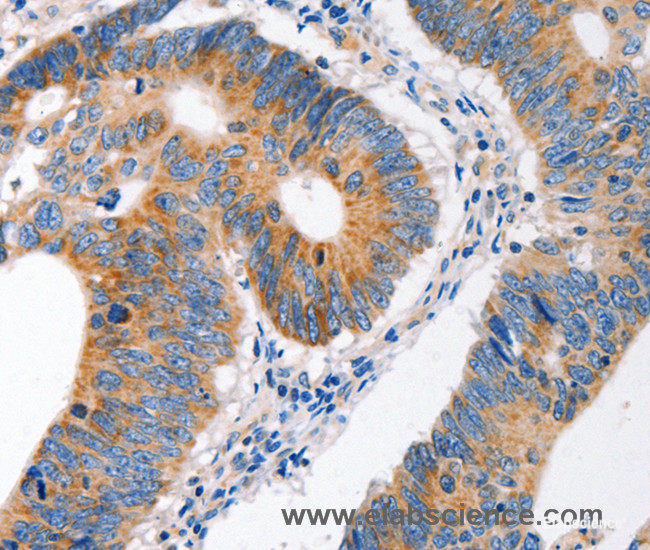 Immunohistochemistry of paraffin-embedded Human colon cancer tissue using MC1R Polyclonal Antibody at dilution 1:100