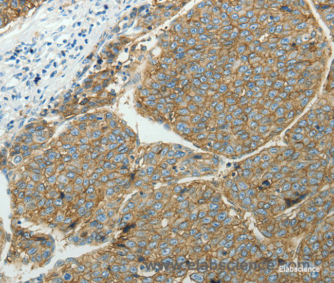 Immunohistochemistry of paraffin-embedded Human liver cancer tissue using SLC16A1 Polyclonal Antibody at dilution 1:50