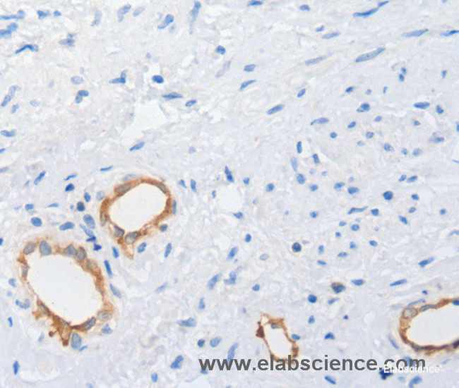 Immunohistochemistry of paraffin-embedded Human cervical cancer tissue using MUC5AC Polyclonal Antibody at dilution 1:100