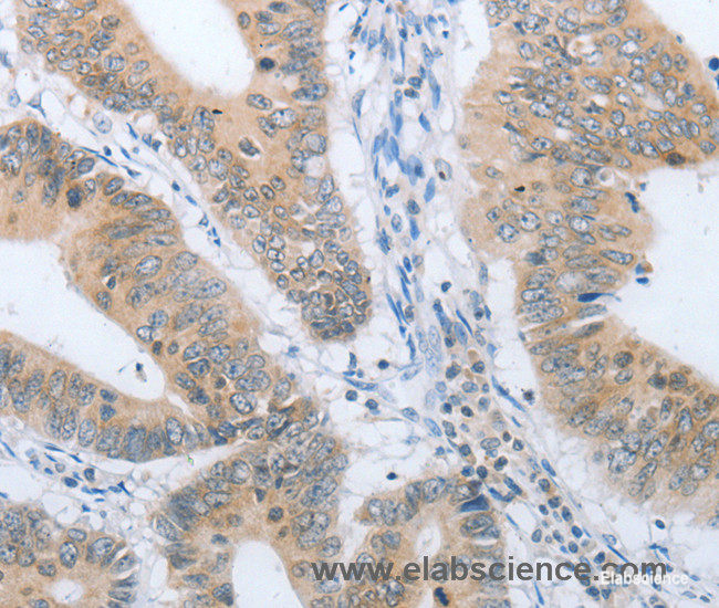 Immunohistochemistry of paraffin-embedded Human colon cancer tissue using CHRNA10 Polyclonal Antibody at dilution 1:50
