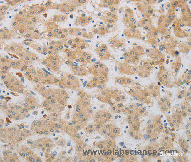 Immunohistochemistry of paraffin-embedded Human liver cancer tissue using NBN Polyclonal Antibody at dilution 1:50
