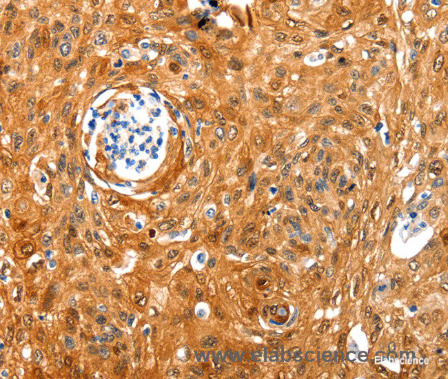 Immunohistochemistry of paraffin-embedded Human cervical cancer tissue using NCOR1 Polyclonal Antibody at dilution 1:100