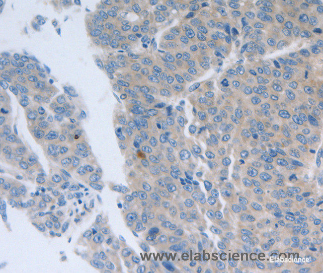 Immunohistochemistry of paraffin-embedded Human liver cancer tissue using GRIN1 Polyclonal Antibody at dilution 1:50