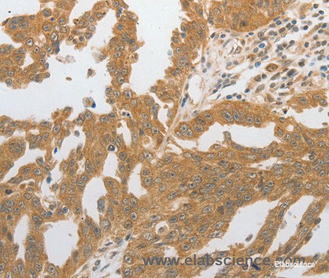 Immunohistochemistry of paraffin-embedded Human ovarian cancer tissue using GRIN2C Polyclonal Antibody at dilution 1:80