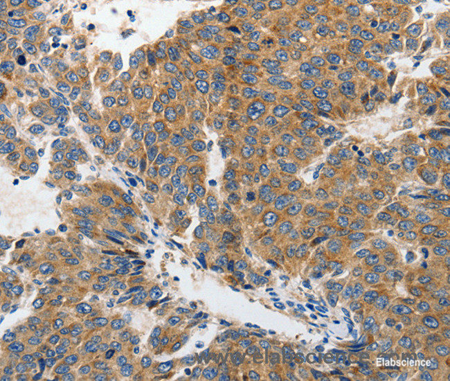 Immunohistochemistry of paraffin-embedded Human liver cancer tissue using GluR2 Polyclonal Antibody at dilution 1:70