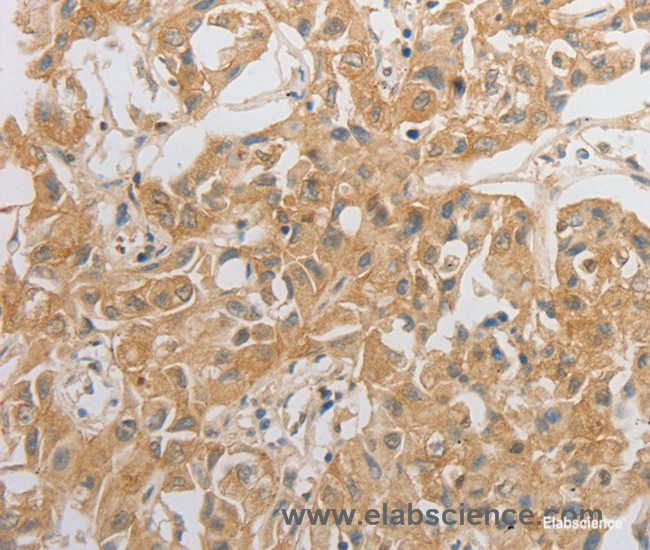 Immunohistochemistry of paraffin-embedded Human lung cancer tissue using HCRTR2 Polyclonal Antibody at dilution 1:50