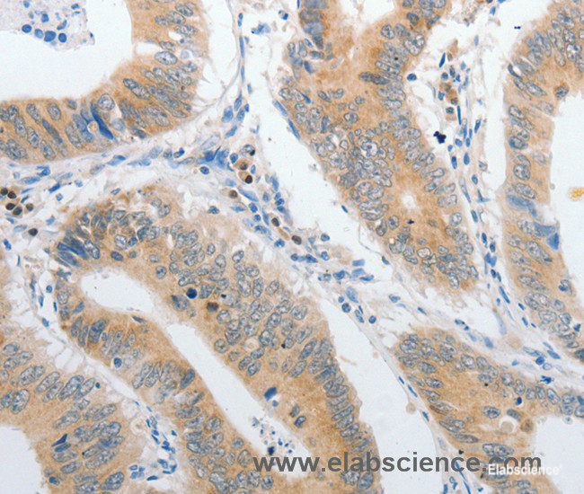 Immunohistochemistry of paraffin-embedded Human colon cancer tissue using PIBF1 Polyclonal Antibody at dilution 1:60