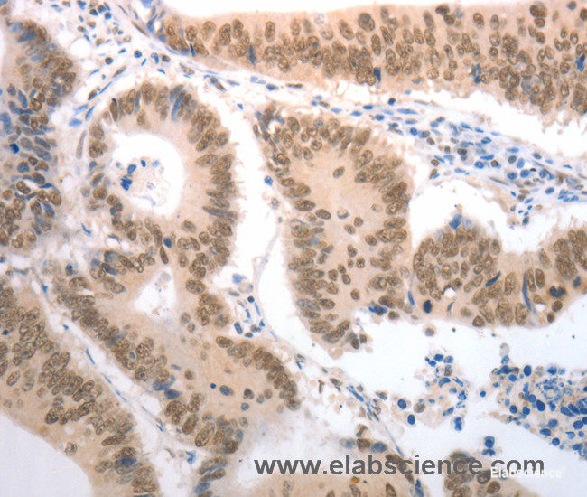 Immunohistochemistry of paraffin-embedded Human colon cancer tissue using RAD52 Polyclonal Antibody at dilution 1:50