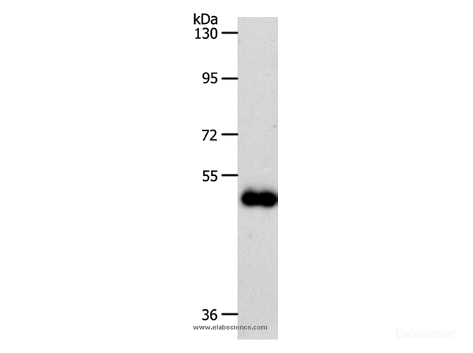 Western Blot analysis of Human colon cancer tissue using SLC39A6 Polyclonal Antibody at dilution of 1:500