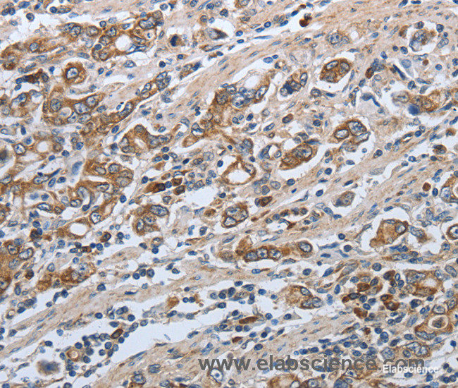 Immunohistochemistry of paraffin-embedded Human gasrtic cancer tissue using SLC34A2 Polyclonal Antibody at dilution of 1:50