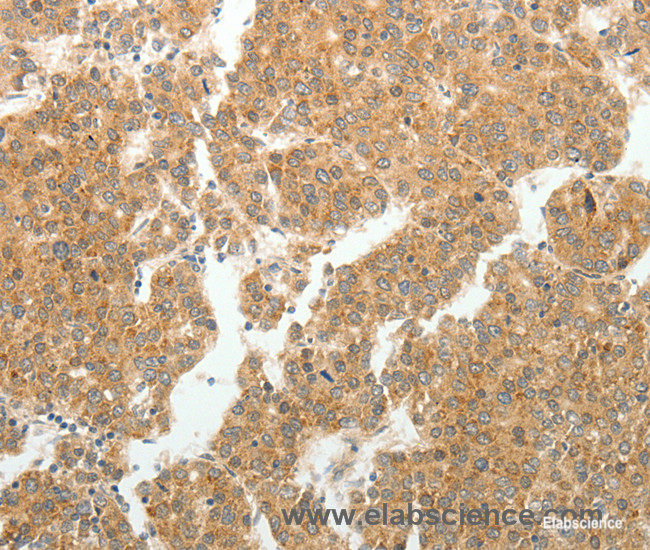 Immunohistochemistry of paraffin-embedded Human liver cancer tissue using GEMIN2 Polyclonal Antibody at dilution 1:40