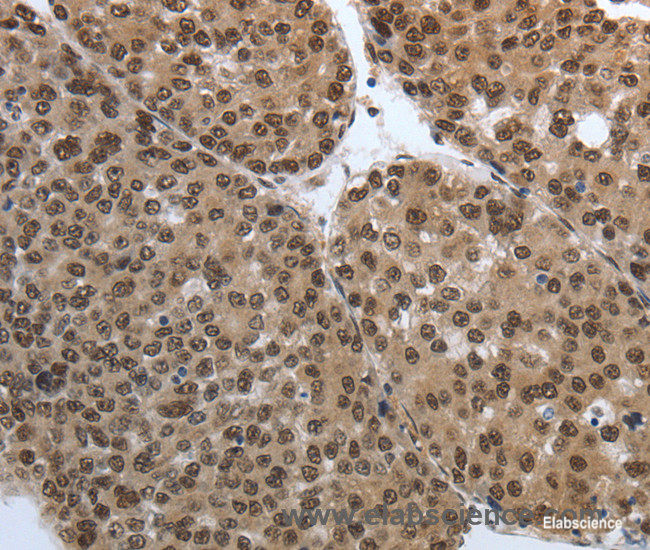 Immunohistochemistry of paraffin-embedded Human liver cancer tissue using SMAD7 Polyclonal Antibody at dilution 1:40