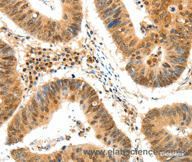 Immunohistochemistry of paraffin-embedded Human colon cancer tissue using TERF2 Polyclonal Antibody at dilution 1:50