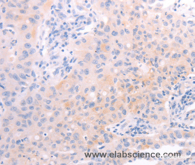 Immunohistochemistry of paraffin-embedded Human lung cancer tissue using AMH Polyclonal Antibody at dilution 1:30